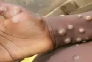 Viruela del mono: el caso sospechoso en Argentina, cómo avanza en el mundo y qué dicen los expertos