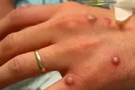 Viruela del mono: el Reino Unido recomendó una cuarentena de 21 días a los contactos estrechos