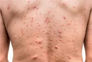 Detectaron partículas compatibles con la viruela del mono en el primer caso sospechoso en Argentina