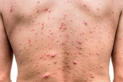 La OMS alertó sobre el aumento de casos de viruela símica y declaró la emergencia de salud pública