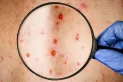 Brasil registra el primer caso de viruela del mono en San Pablo