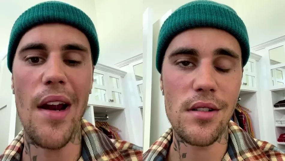 PARÁLISIS FACIAL. Justin Bieber les mostró fotos a sus seguidores para contarles cómo es la enfermedad que está atravesando. 