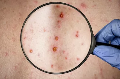 Viruela del mono: detectaron el primer caso en Santa Fe