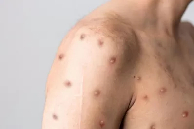 Viruela del mono: el Ministerio de Salud confirmó 49 infectados en Argentina