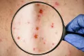 Detectaron el primer caso de viruela del mono en Jujuy