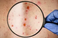 Detectaron el primer caso de viruela del mono en Jujuy