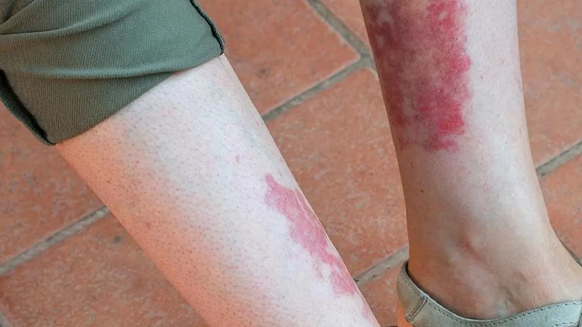 Especialista tucumana explica que son las Vasculitis y cómo reconocerlas