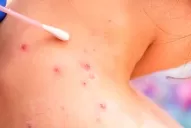 Viruela del mono en Tucumán: recomendaciones para evitar el contagio