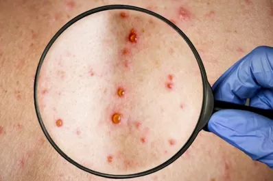 Viruela del mono: el Ministerio de Salud confirmó 396 casos en Argentina