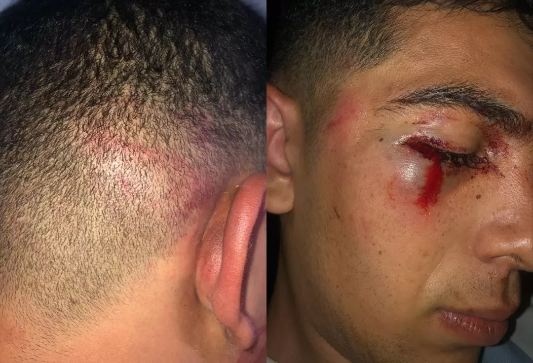 BRUTAL GOLPIZA. El joven podría tener consecuencias en el ojo izquierdo.