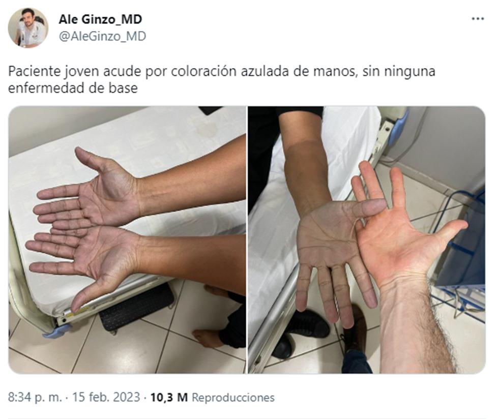 Un médico atendió a un joven con las manos azules y el diagnóstico sorprendió a todos