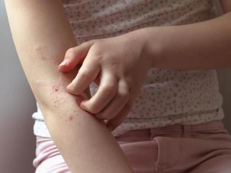 DERMATITIS. No es contagiosa, pero pica mucho, lastima e infecta la piel. 