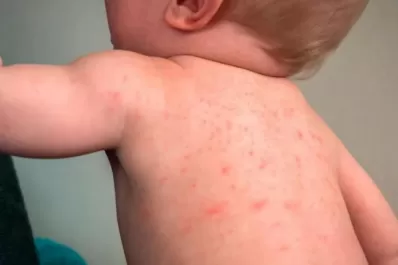 Dengue en niños: cuáles son los síntomas y cómo es el tratamiento