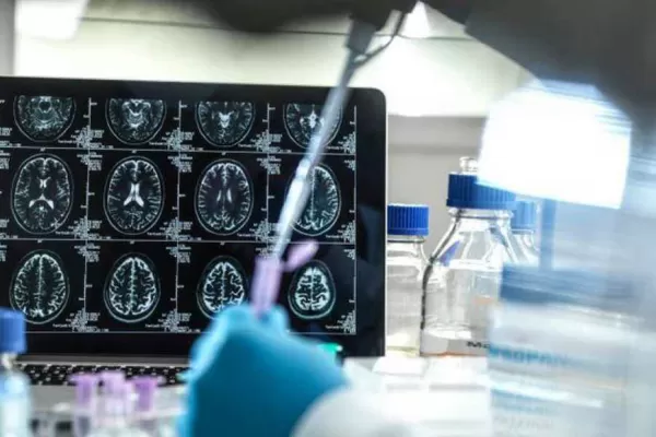 Alzheimer: con Inteligencia Artificial identifican genes y aceleran el desarrollo de medicamentos