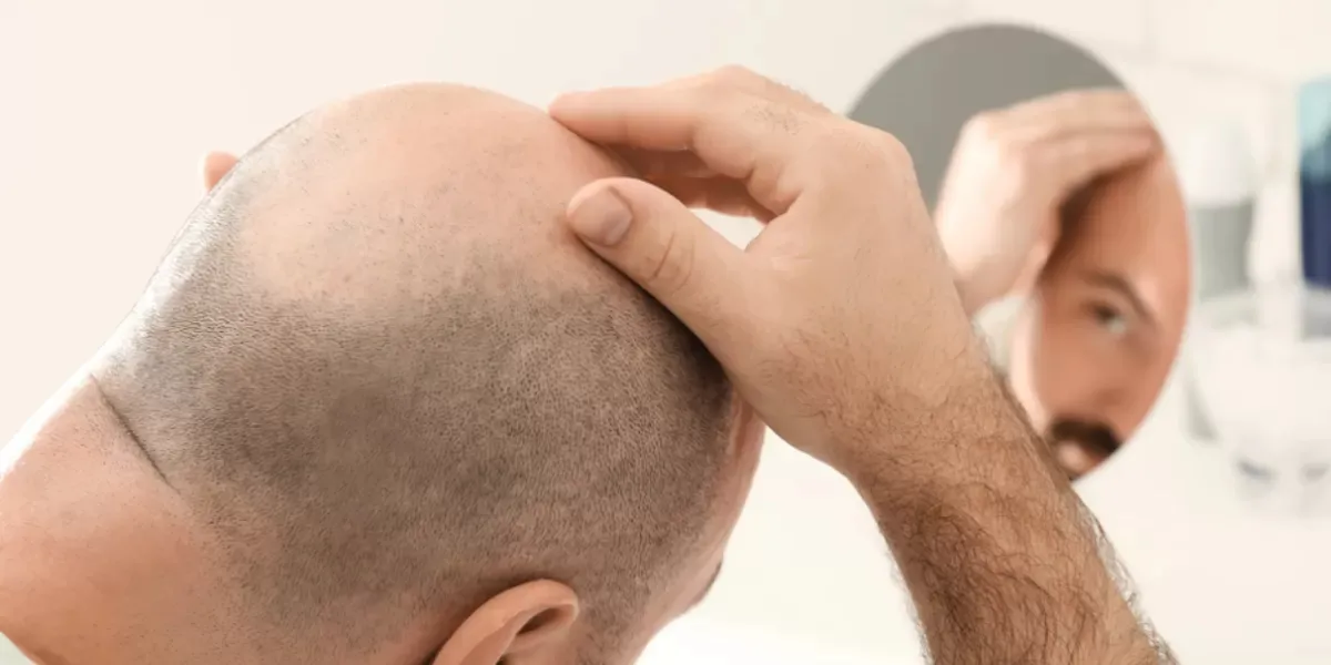 A tener en cuenta: cómo saber si te vas a quedar calvo