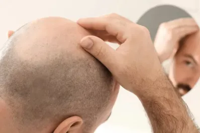 Cómo saber si estás en riesgo de quedarte pelado: señales a tener en cuenta