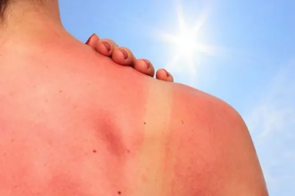 Cáncer de piel: el ABC para una autoexploración que permite reconocer señales de alarma