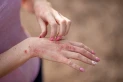 Dermatitis atópica en verano: efectos negativos y cuidados