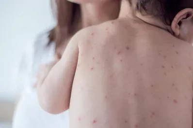 Nuevo caso de sarampión en Argentina: es un bebé que llegó desde España