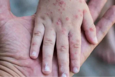 Brote de sarampión: cuáles son los países más afectados en América