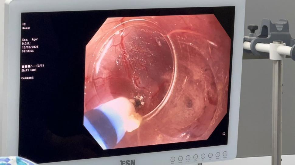 EL PROCEDIMIENTO. Imagen en la pantalla de un momento de la operación.