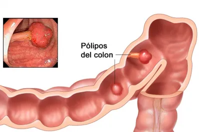 Detectar el cáncer de colon a tiempo: el test que puede salvar tu vida