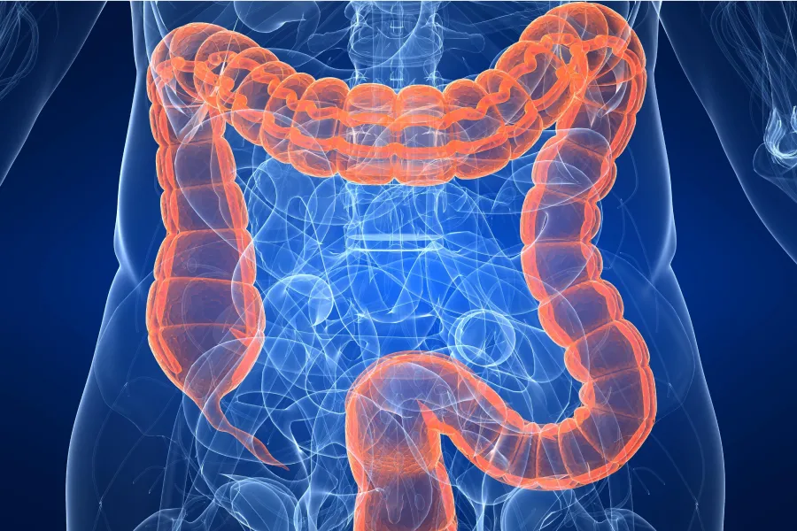 El cáncer de colon es cada vez más frecuente en jóvenes