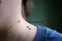 Verrugas en el cuello: por qué aparecen y cómo tratarlas