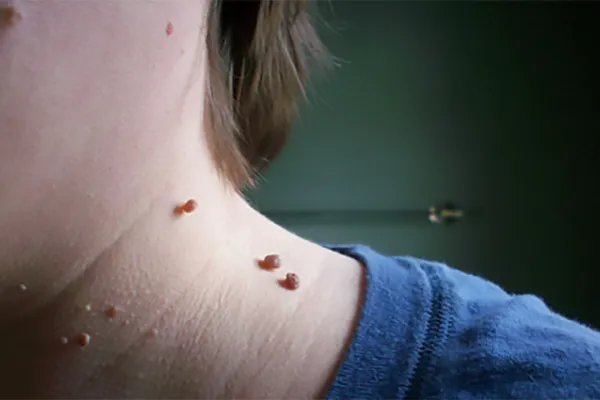 ¿Por qué aparecen verrugas en el cuello y cómo eliminarlas?