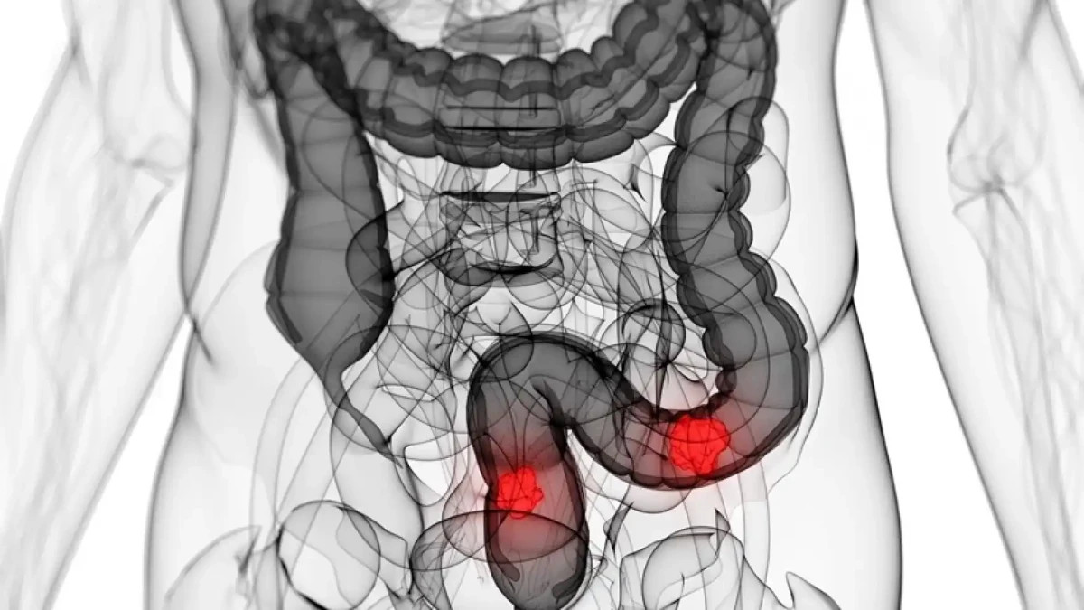 El cáncer de colón y una tendencia alarmante que afecta a los más jóvenes.