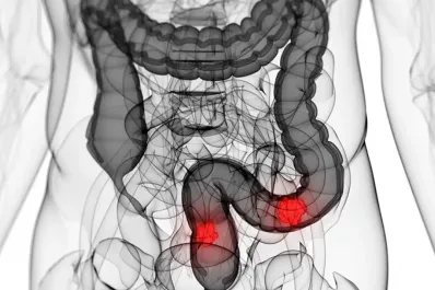 Cáncer de colón: cada vez son más los adultos jóvenes que padecen esta enfermedad