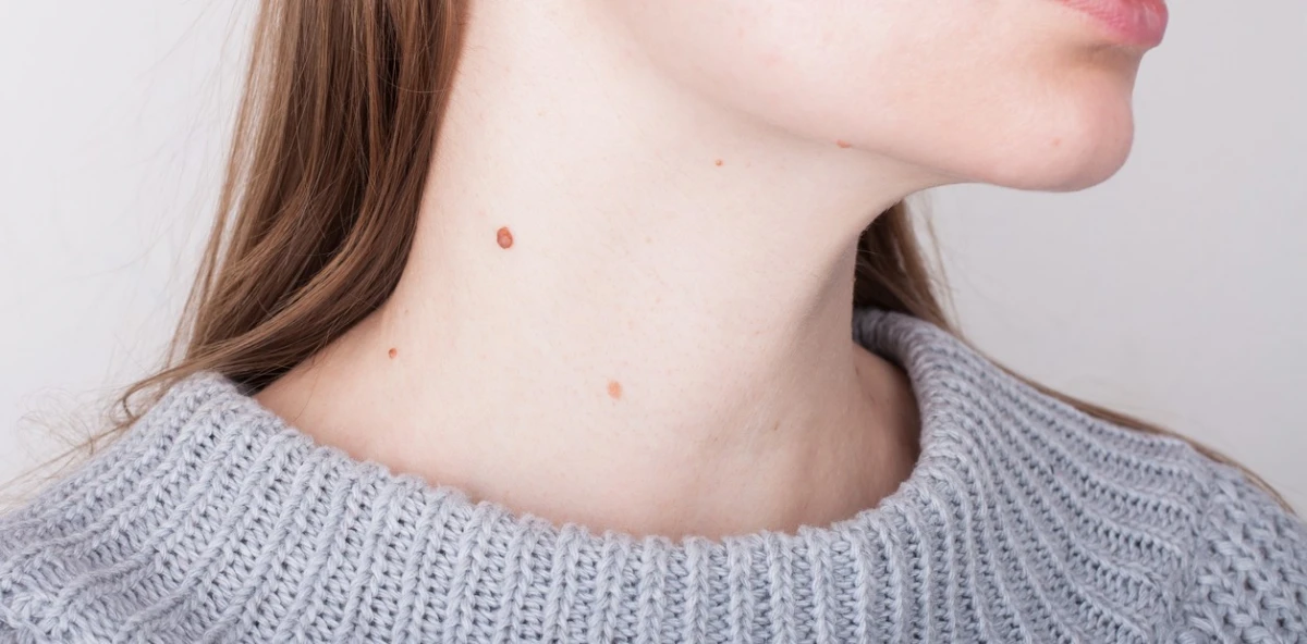 Verrugas en el cuello: cómo eliminarlas con alternativas caseras y no recurrir a cirugía