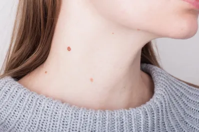 Cómo eliminar verrugas en el cuello de forma natural y sin pasar por el quirófano