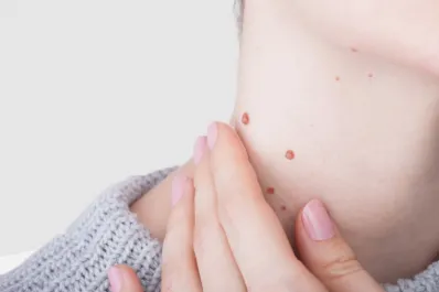 ¿Por qué salen verrugas en el cuello? Contagio y señales de alerta