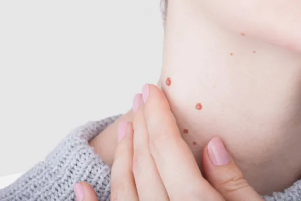 ¿Por qué salen verrugas en el cuello? Causas, contagio y cuándo preocuparse
