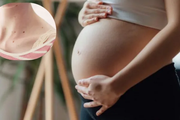Verrugas en el cuello durante el embarazo: ¿cuáles son sus causas y qué posibilidades hay de contagiar a los bebés?