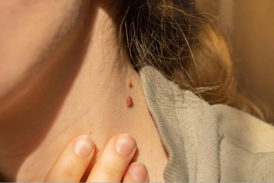 Verrugas en el cuello: cuál es el tratamiento más efectivo para eliminarlas, según los dermatólogos