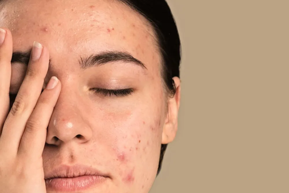 Acné por estrés: qué es, cuáles son sus principales causas y cómo tratarlo 