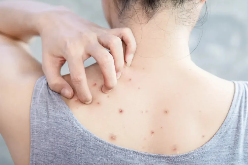 Cómo eliminar de manera sencilla los granos de la espalda y cola