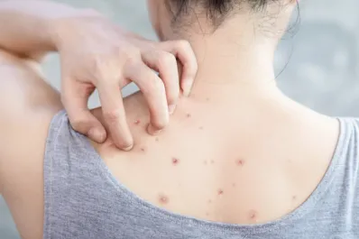 Cómo eliminar los granos de la espalda y la cola de forma fácil y rápida