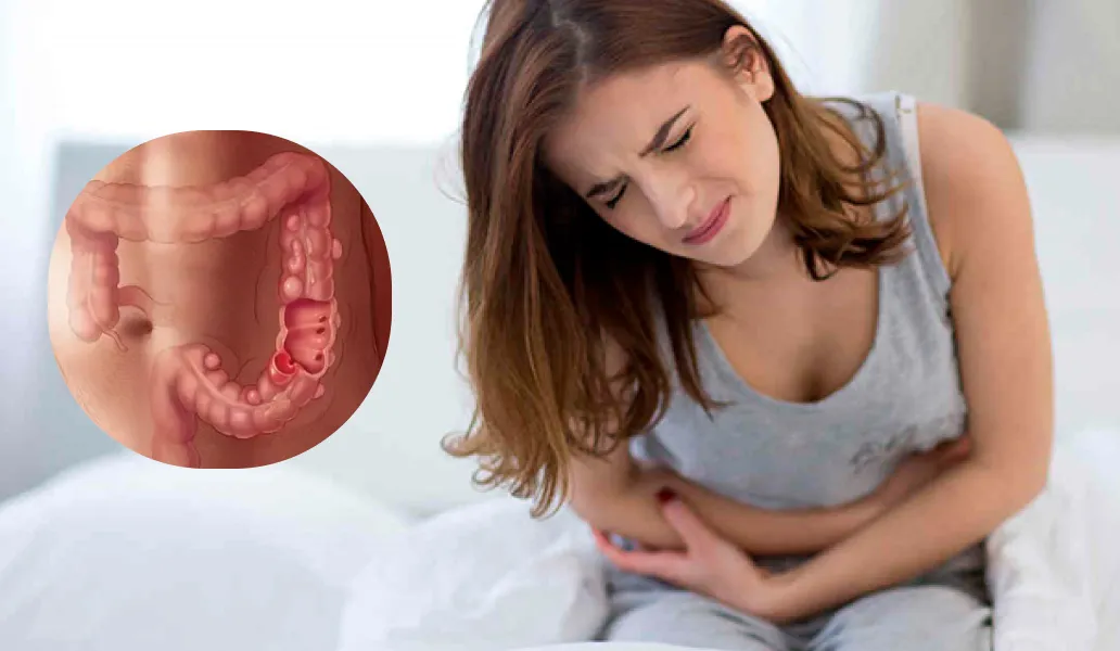 Qué es la diverticulosis, cuáles son sus síntomas y a qué edad puede aparecer