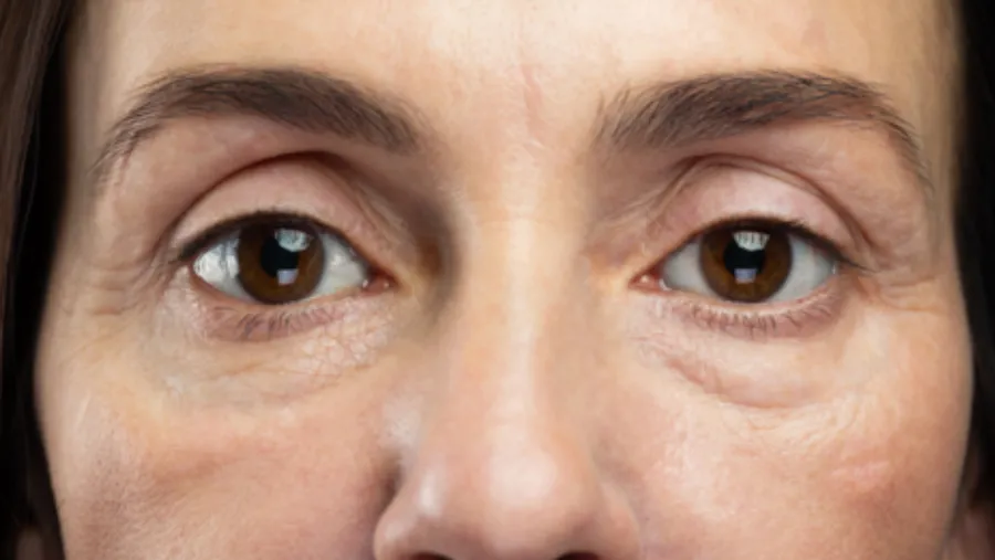 Cuáles son las causas de las ojeras y cuándo deberíamos preocuparnos 