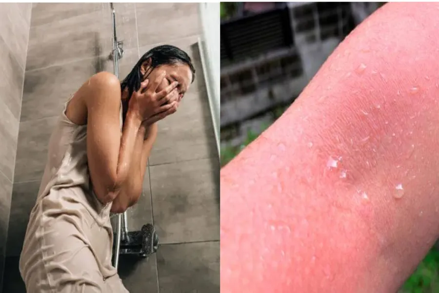 Urticaria acuágenica: la enfermedad que provoca alergia al agua