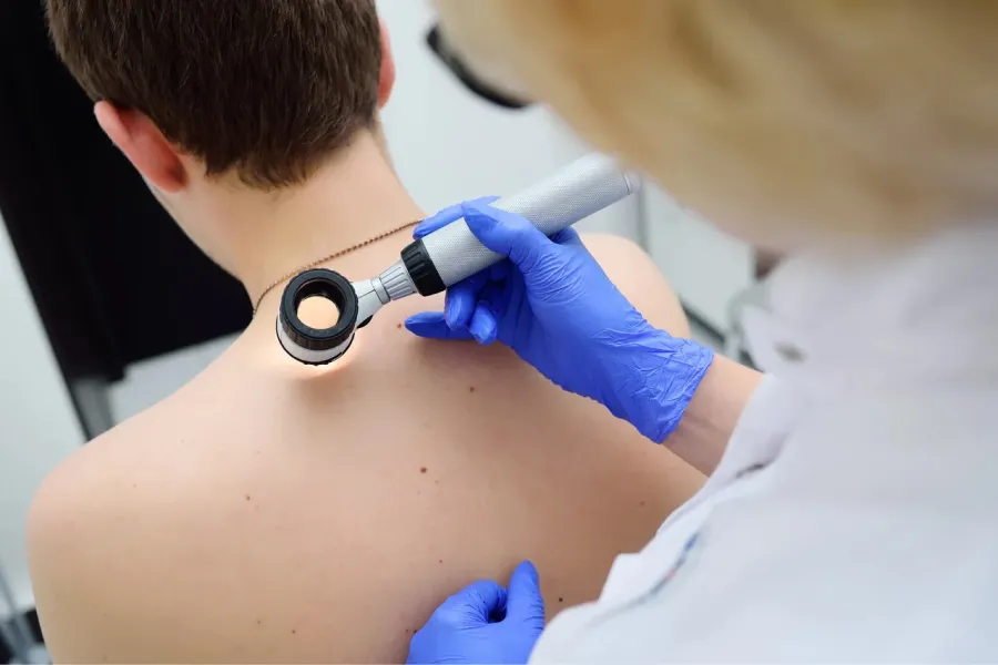Cáncer de piel: los chequeos médicos regulares son clave para prevenirlo