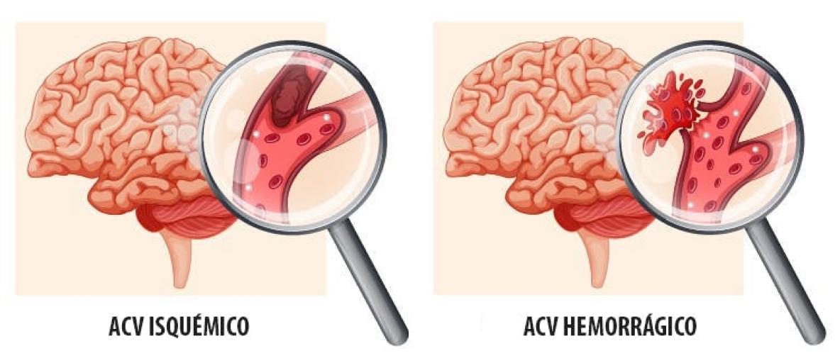 Cómo reconocer un derrame cerebral: las cinco señales más comunes