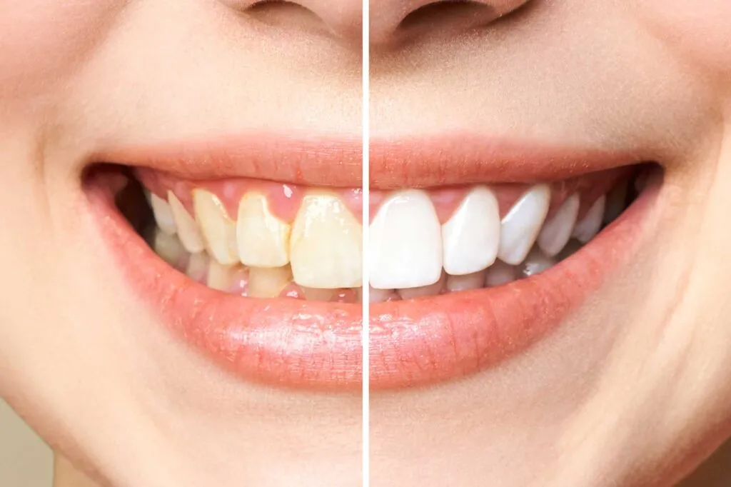Cuáles son los dos remedios caseros más recomendados para sacar el sarro de los dientes