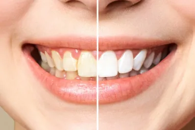 Cuáles son los dos remedios caseros más recomendados para sacar el sarro de los dientes