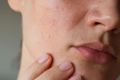 Rosácea: qué es, cómo cuidarla y los mejores tratamientos disponibles