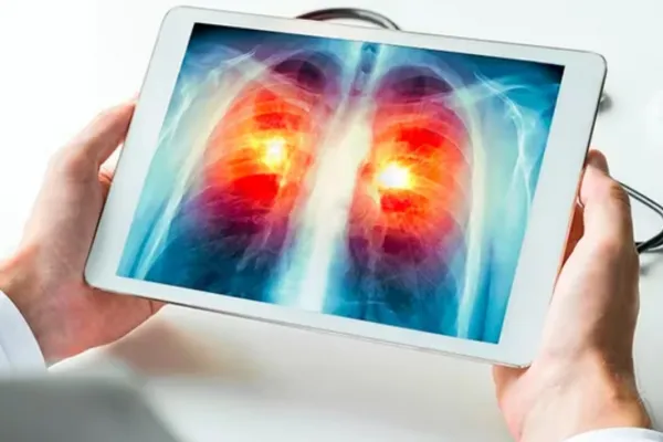 Detectar el cáncer de pulmón a tiempo: los síntomas que no debes ignorar