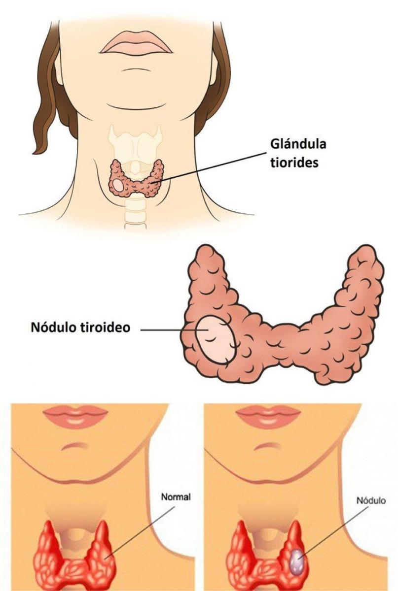 Cómo saber si un bulto en el cuello es señal de cáncer de tiroides
